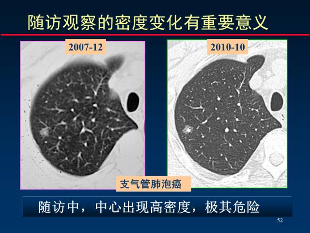 【PPT】肺癌CT征象的再探讨