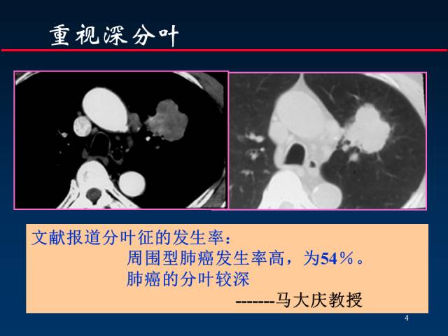 【PPT】肺癌CT征象的再探讨
