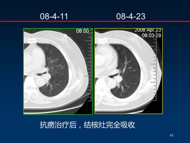 【PPT】肺癌CT征象的再探讨