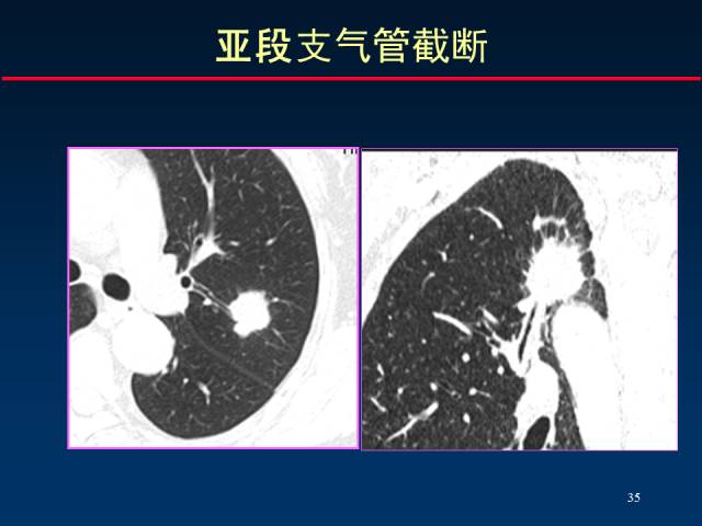 【PPT】肺癌CT征象的再探讨