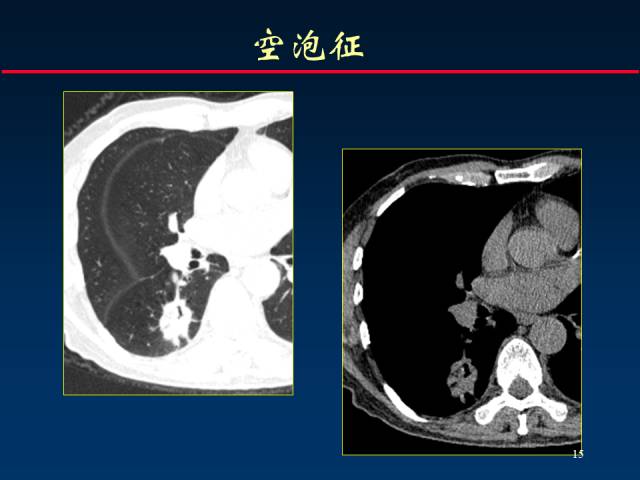 【PPT】肺癌CT征象的再探讨