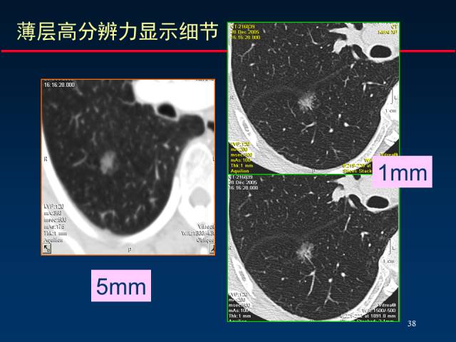 【PPT】肺癌CT征象的再探讨