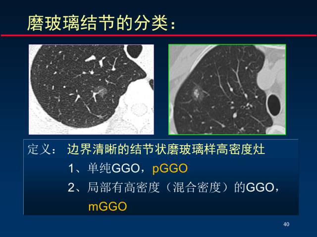 【PPT】肺癌CT征象的再探讨