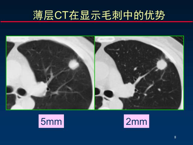 【PPT】肺癌CT征象的再探讨