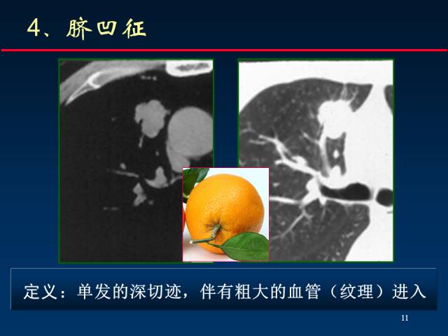 【PPT】肺癌CT征象的再探讨