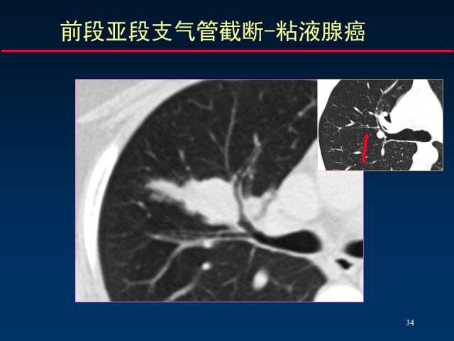 【PPT】肺癌CT征象的再探讨