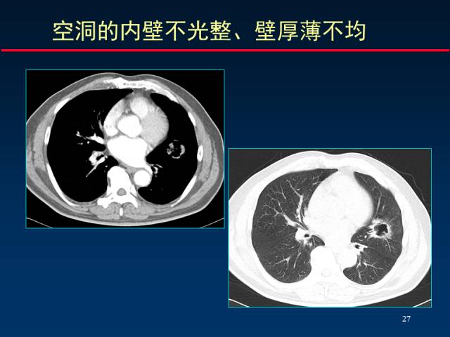 【PPT】肺癌CT征象的再探讨