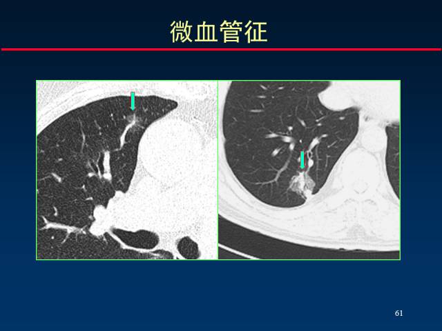 【PPT】肺癌CT征象的再探讨