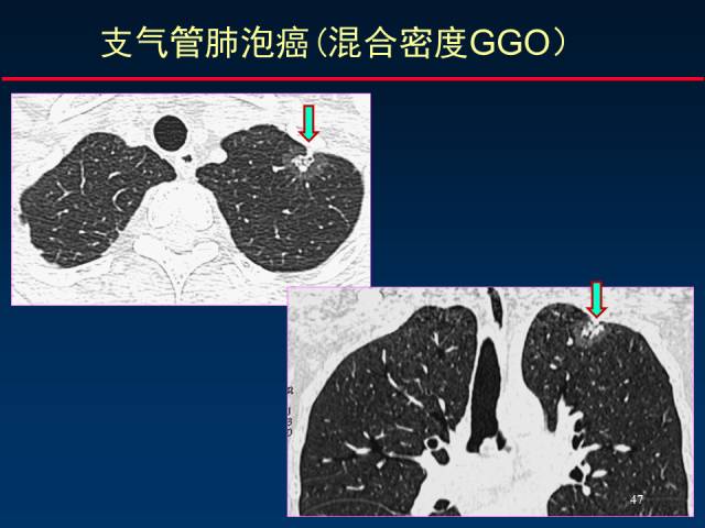 【PPT】肺癌CT征象的再探讨