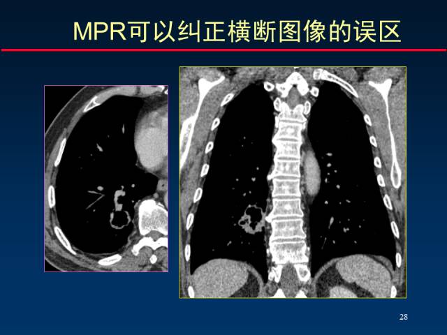 【PPT】肺癌CT征象的再探讨