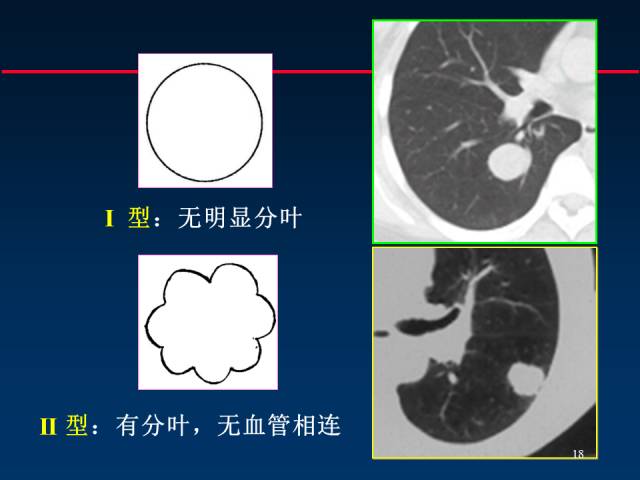 【PPT】肺癌CT征象的再探讨