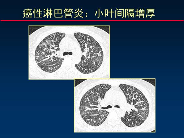 【PPT】肺癌CT征象的再探讨