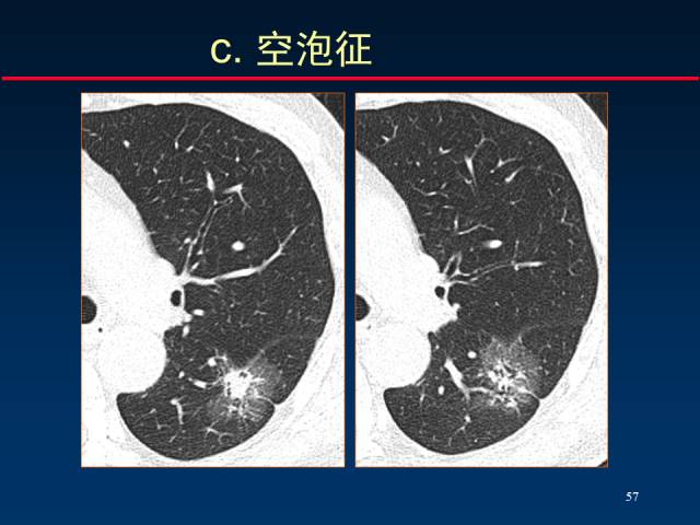 【PPT】肺癌CT征象的再探讨