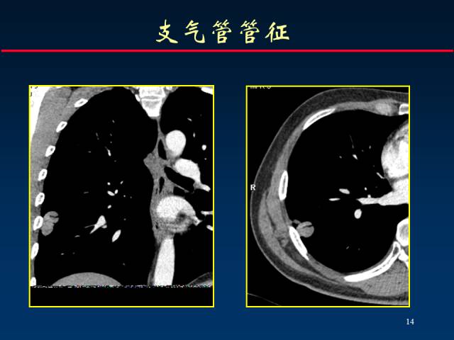【PPT】肺癌CT征象的再探讨