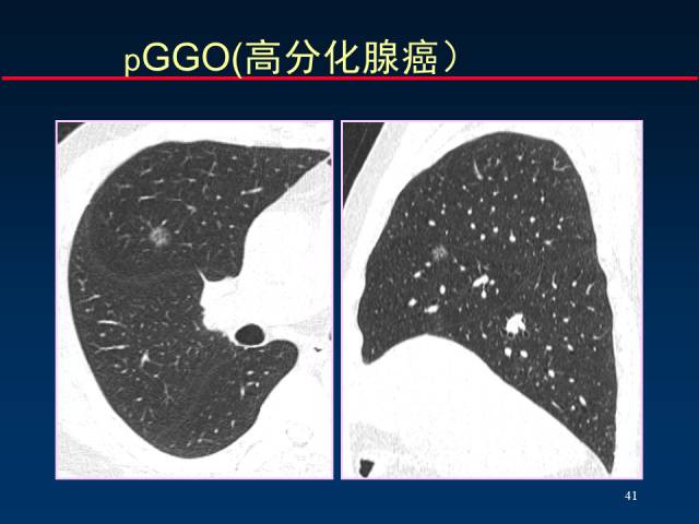 【PPT】肺癌CT征象的再探讨