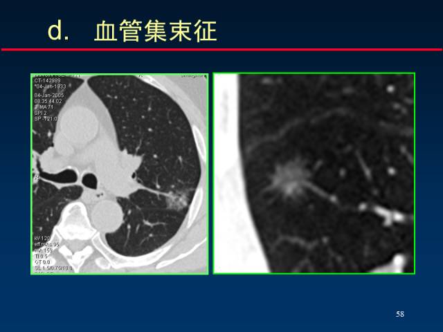 【PPT】肺癌CT征象的再探讨