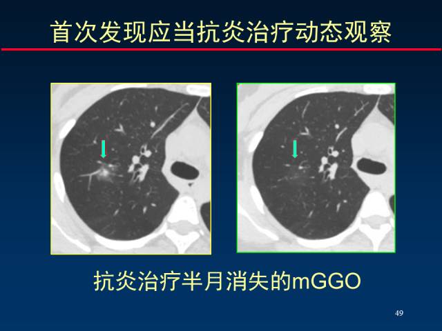 【PPT】肺癌CT征象的再探讨