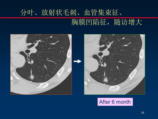 【PPT】肺癌CT征象的再探讨