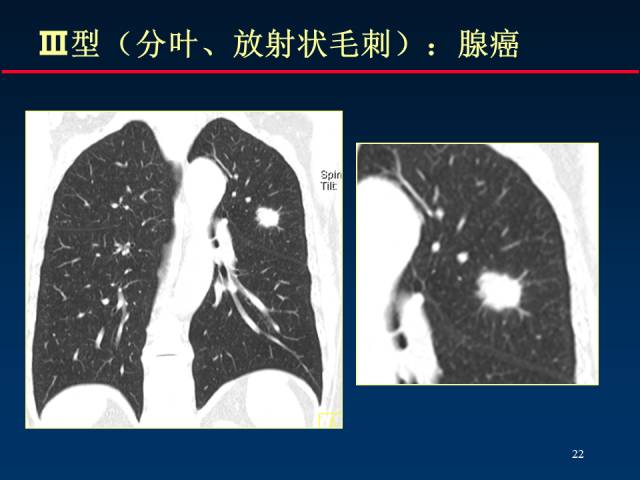 【PPT】肺癌CT征象的再探讨