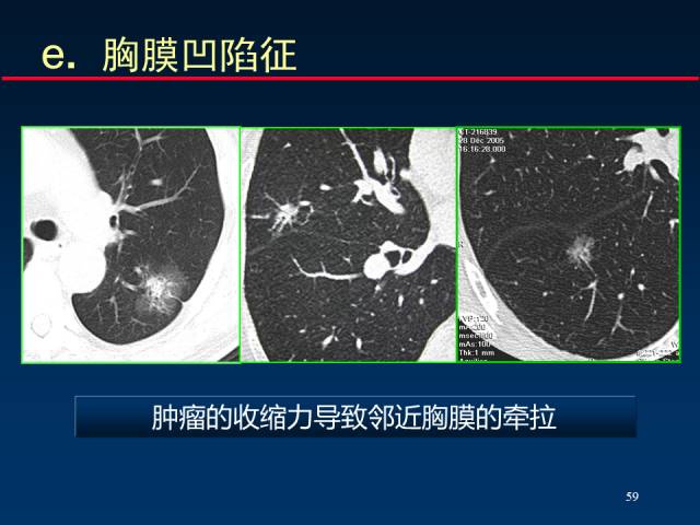 【PPT】肺癌CT征象的再探讨