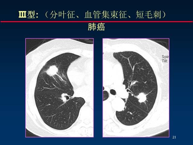 【PPT】肺癌CT征象的再探讨