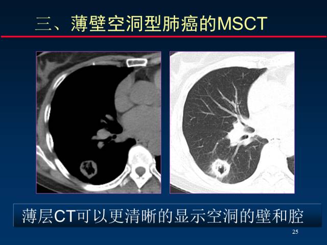 【PPT】肺癌CT征象的再探讨