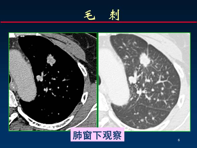 【PPT】肺癌CT征象的再探讨