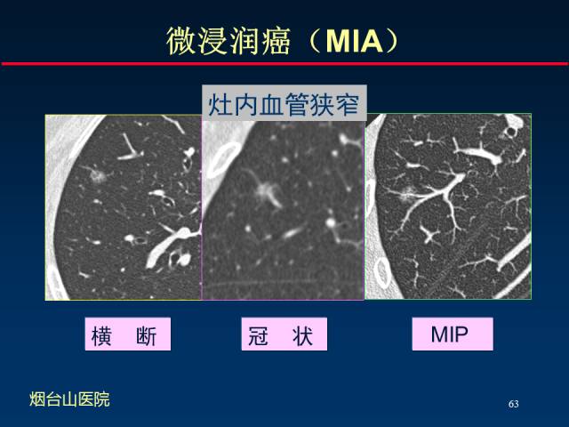 【PPT】肺癌CT征象的再探讨