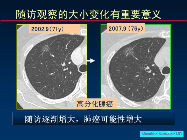 【PPT】肺癌CT征象的再探讨