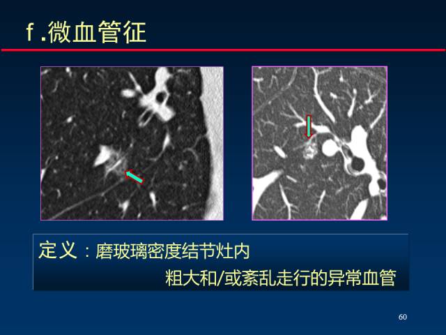 【PPT】肺癌CT征象的再探讨