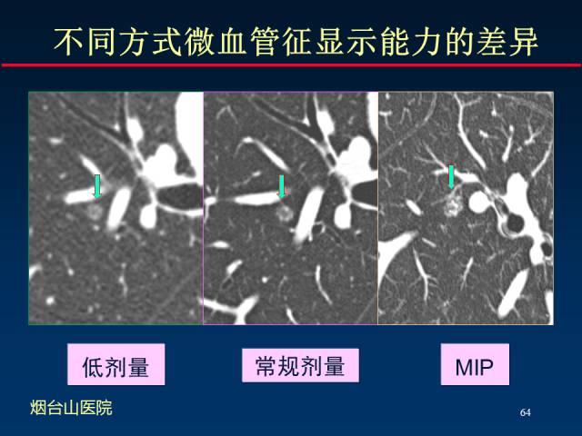 【PPT】肺癌CT征象的再探讨
