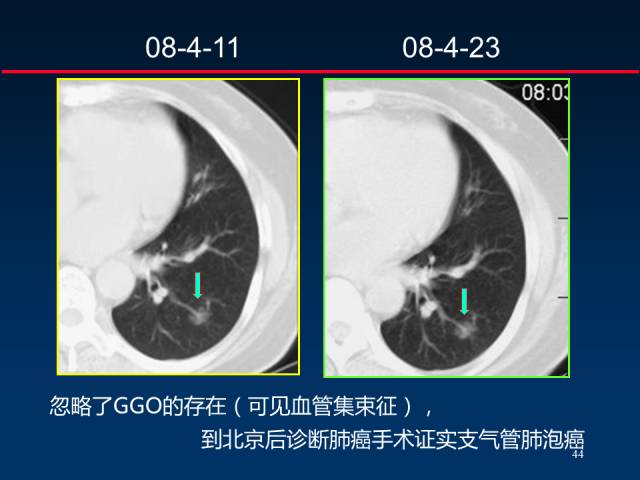 【PPT】肺癌CT征象的再探讨