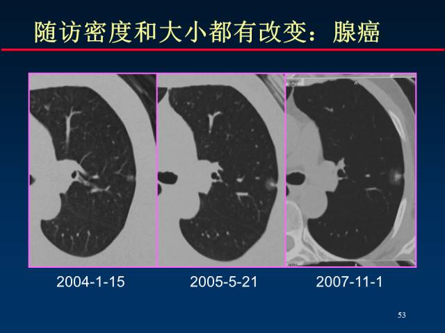 【PPT】肺癌CT征象的再探讨