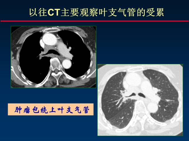 【PPT】肺癌CT征象的再探讨