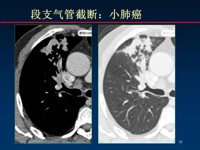 【PPT】肺癌CT征象的再探讨
