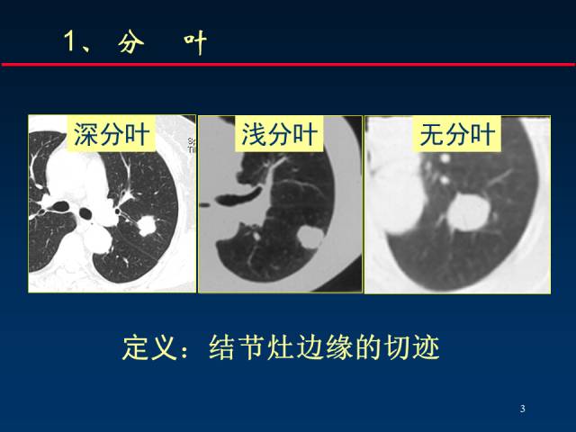 【PPT】肺癌CT征象的再探讨