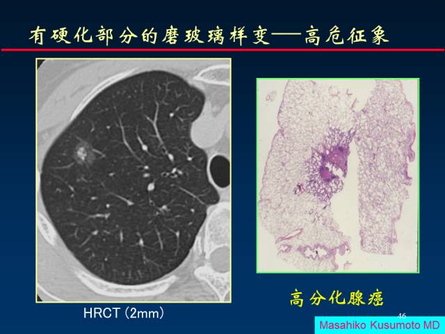 【PPT】肺癌CT征象的再探讨