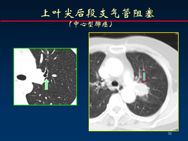 【PPT】肺癌CT征象的再探讨