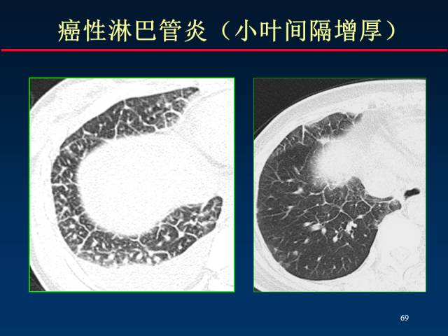 【PPT】肺癌CT征象的再探讨