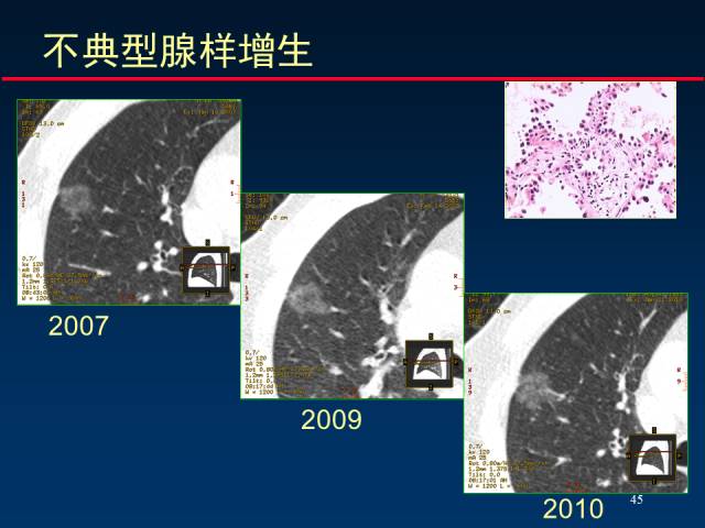 【PPT】肺癌CT征象的再探讨