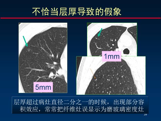 【PPT】肺癌CT征象的再探讨