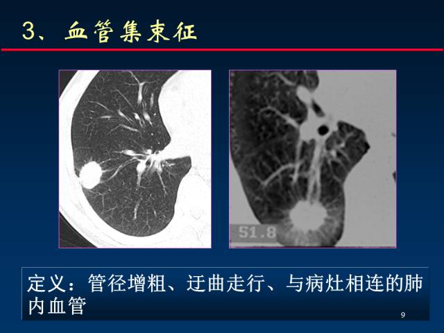 【PPT】肺癌CT征象的再探讨