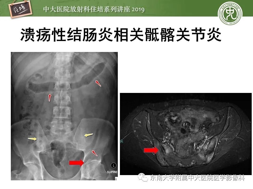 【PPT】强直性脊柱炎影像学评估
