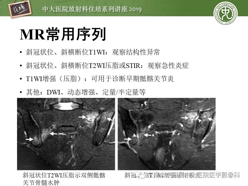 【PPT】强直性脊柱炎影像学评估