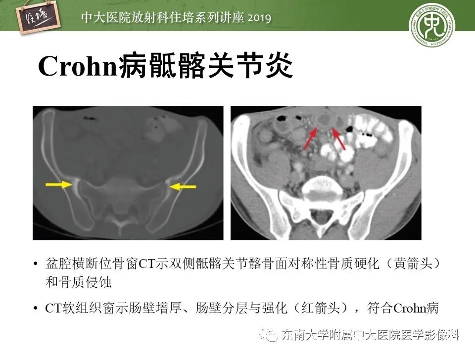 【PPT】强直性脊柱炎影像学评估