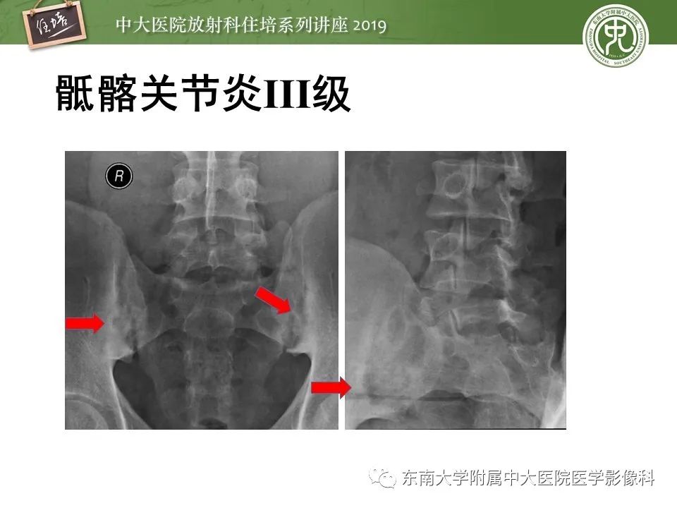 【PPT】强直性脊柱炎影像学评估