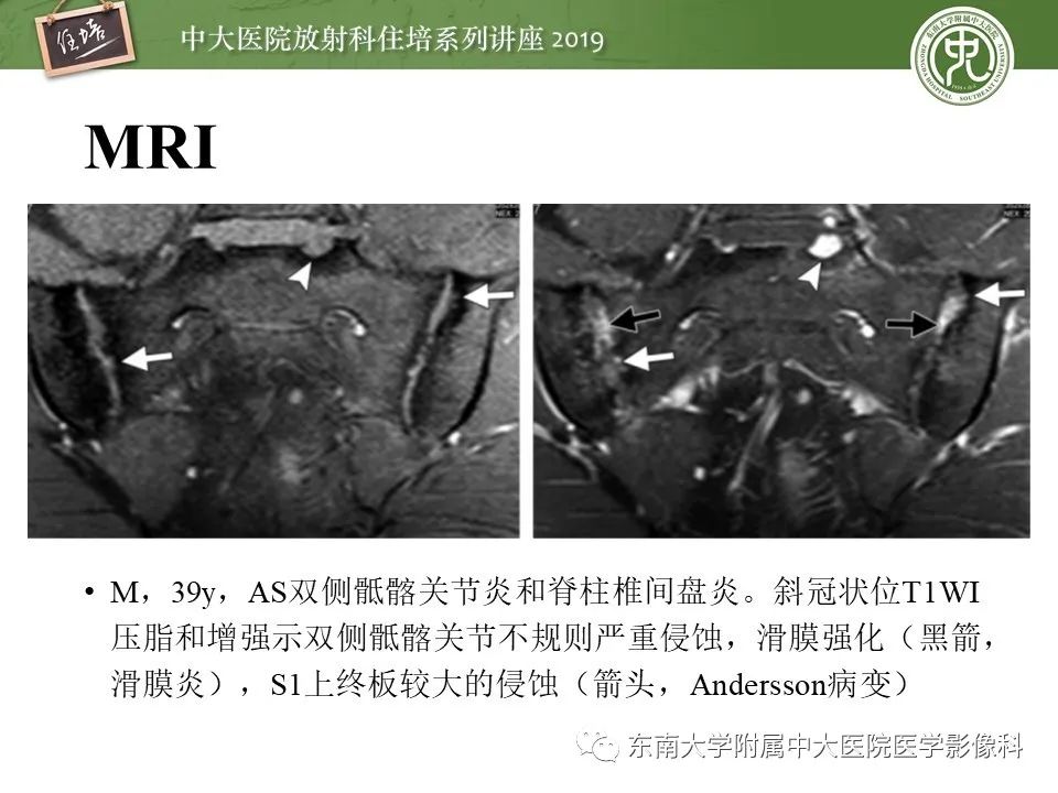 【PPT】强直性脊柱炎影像学评估