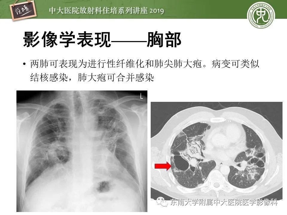 【PPT】强直性脊柱炎影像学评估
