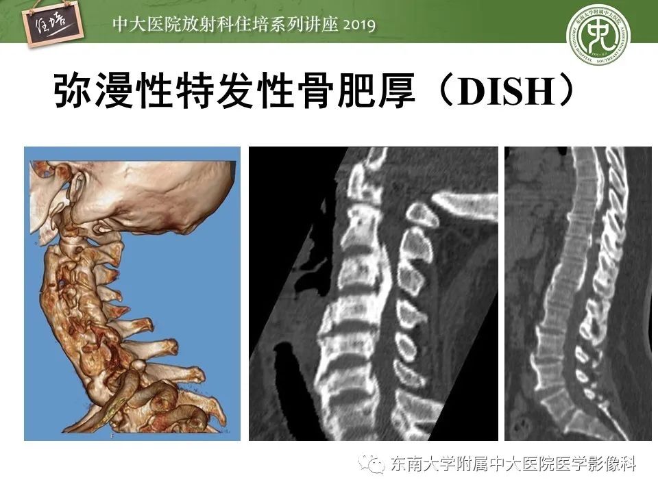 【PPT】强直性脊柱炎影像学评估