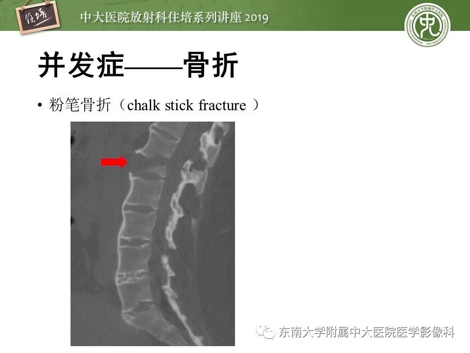 【PPT】强直性脊柱炎影像学评估